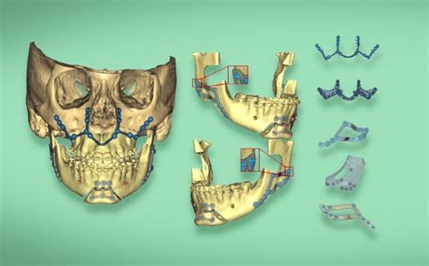 Reconstrucci N Mandibular En D La Medicina Del Futuro Grupo Milenio