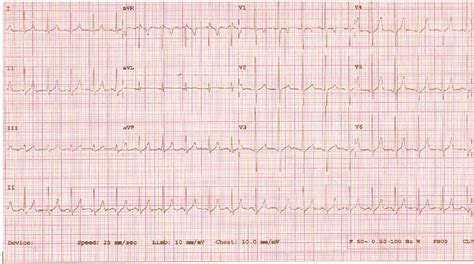 Ecg Shows Peaked Tented T Wave Which Indicate Hyperkalemia Download Scientific Diagram