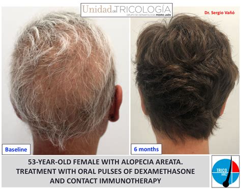 Alopecia Areata Solución causas problema tratamiento especialista