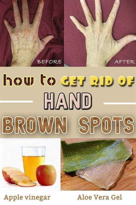 How To Get Rid Of Hand Brown Spots Brown Spots On Hands Brown Spots Brown Spots On Skin