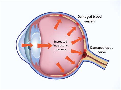 Glaucoma Eye Diagram