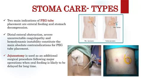 Stoma care / for surgeons | PPT