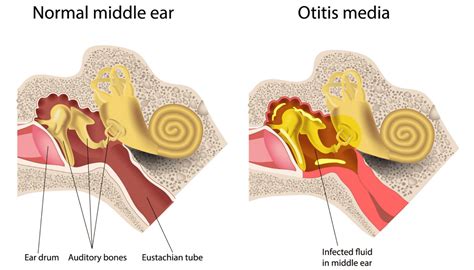 Patient Basics Middle Ear Infection Otitis Media Minute Medicine | Hot Sex Picture