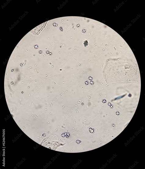 Microscopic Image Showing Calcium Oxalate Monohydrate And Dihydrate