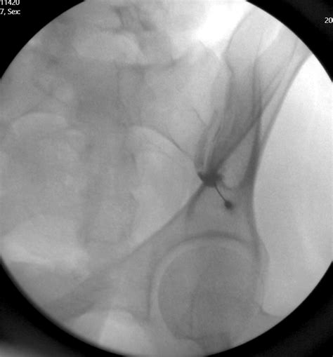 Si joint injection | Page 2 | Student Doctor Network