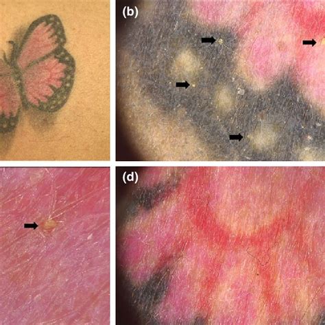 A Erythematous To Violaceous Plaques On The Popliteal Fossa B