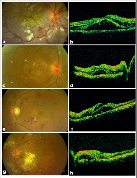 Varied Clinical Associations Of Serous Macular Detachment In Malignant