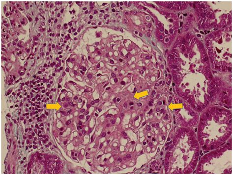 Focal Proliferative Glomerulonephritis Accompanied By Mononuclear Cells Download Scientific