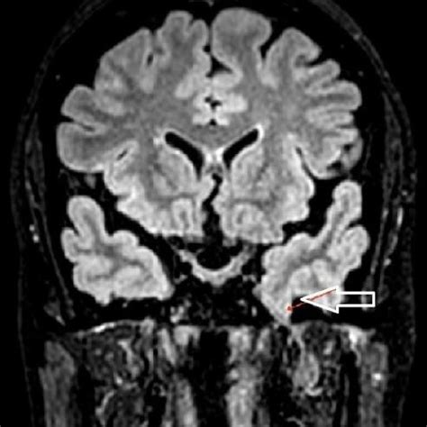 MRI Brain FLAIR sequence showing A-herniation of right inferior ...