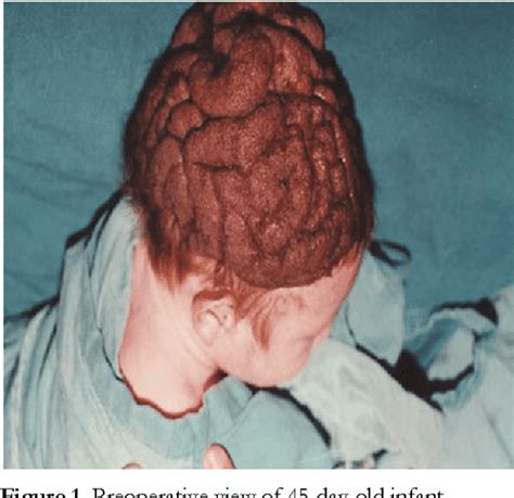 Figure 1 From Aesthetic Reconstruction Of Congenital Cerebriform