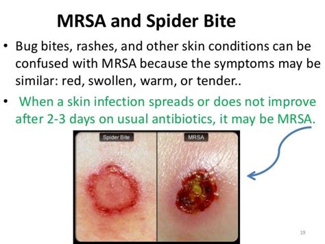 Mrsa