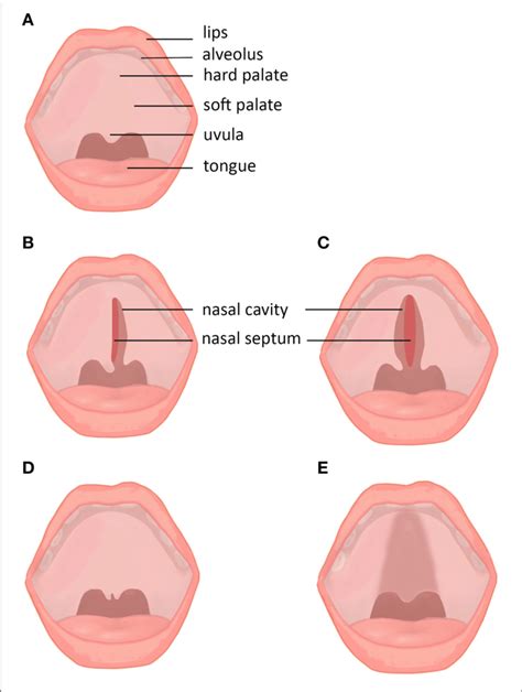 | Subtypes and subclinical forms of cleft palate. (A) Normal lip and ...