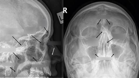 Sinuses XRAY - WEEK 2 Diagram | Quizlet