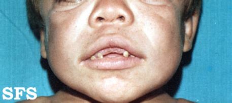 Hurler syndrome physical examination - wikidoc