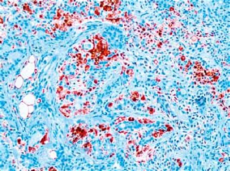 Cytoplasmic Immunostaining In The Plasmacytoid Myoepithelial Cells With Download Scientific