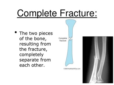 Skeletal Pathologies Flashcards Quizlet