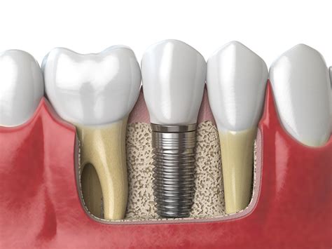 Benefits Of Endosteal Subperiosteal Implants Dental Implant