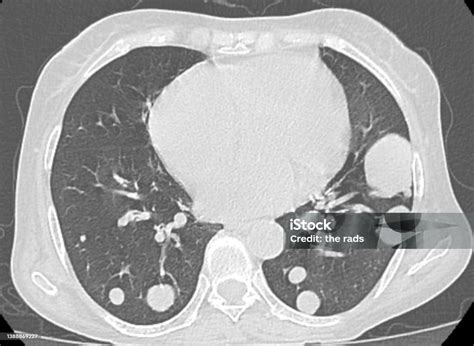 Bola Meriam Jenis Metastasis Paru Ct Scan Dada Foto Stok Unduh Gambar