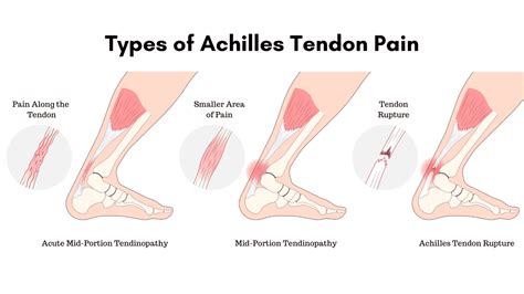 Achilles Tendinopathy Anatomy Function Diagnosis And Treatment