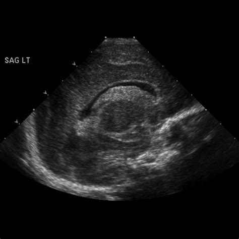 Subependymal Germinal Matrix