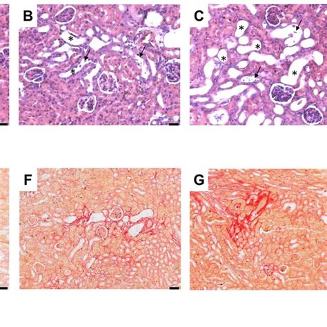 Kinin B Receptor Antagonism Worsens Cisplatin Induced Tubular Injury