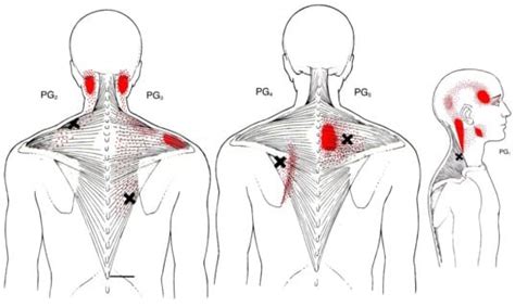 Dolor Muscular Trapecio