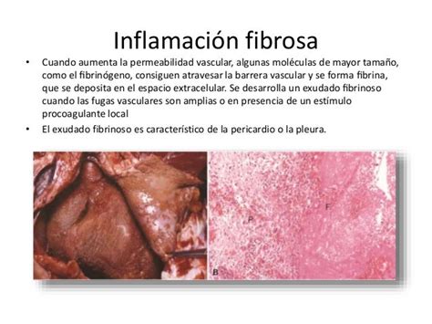 Inflamación Aguda Y Cronica