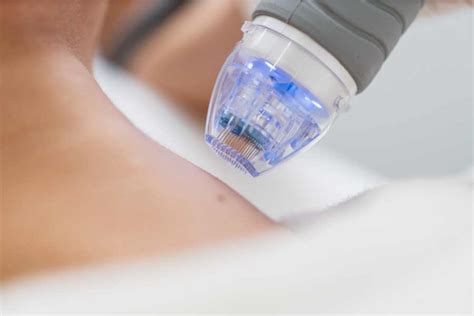 Fractional RF Needling Plasma Skin Tightening Mirra Skin Aesthetic