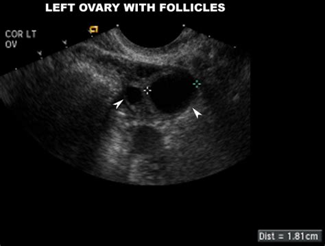 Pelvic Anatomy