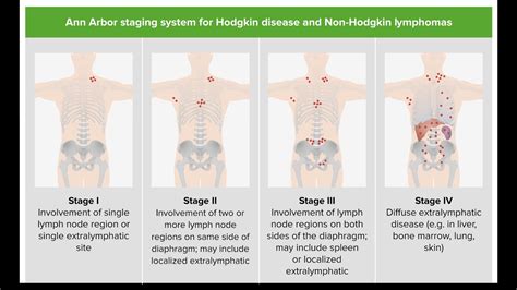 Treating Classic Hodgkin Lymphoma By Stage Youtube