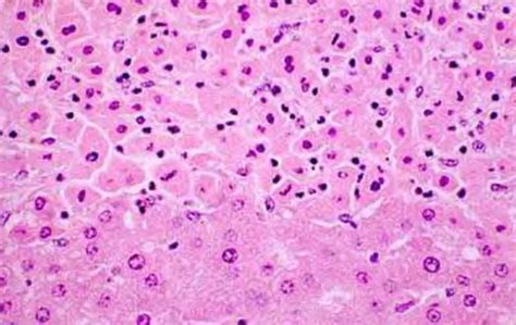 General Pathology I Necrosis And Postmortem Autolysis Flashcards Quizlet