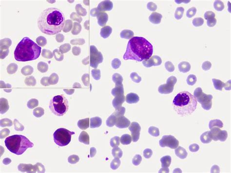 Medical Laboratory and Biomedical Science: Auer rods in dysplastic granulocyte