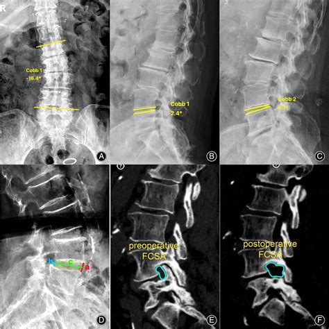 Uniportal Fullendoscopic Foraminotomy For Lumbar Foraminal Stenosis