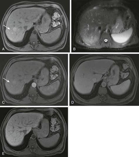 Malignant Tumors Of The Liver Radiology Key