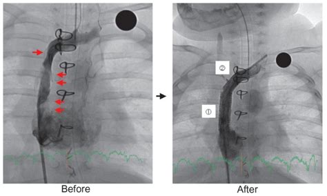 Stent implantation in the superior vena cava. Angiographic defects due ...