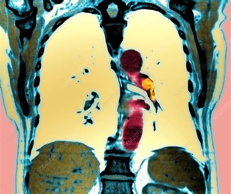 Pulmonary embolism, CT scan - Stock Image - M175/0372 - Science Photo Library