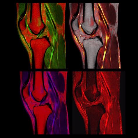 acl reconstruction | coachingultrasound