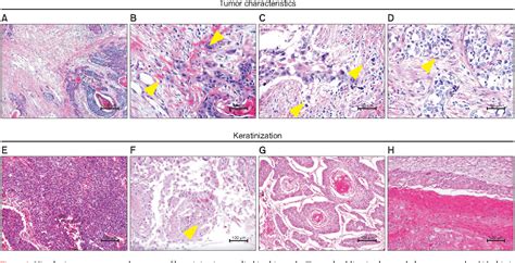 Squamous Cell Carcinoma Lung