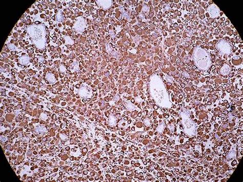 Anaplastic Carcinoma Thyroid Gland Bosnianpathology