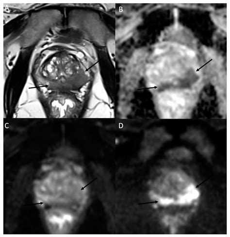 Jcm Free Full Text Diffusion Weighted Mri In The Genitourinary System