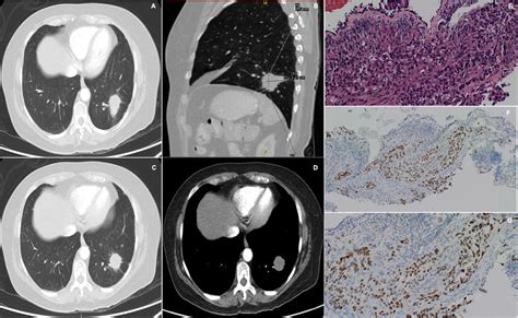 A B C D Chest Ct Showing Lung Parenchyma With Normal Morphology And