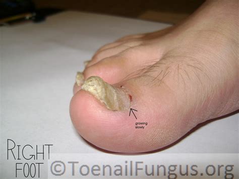 Improving Fungus Feet using Vinegar and Tee Tree Oil – Toenail Fungus