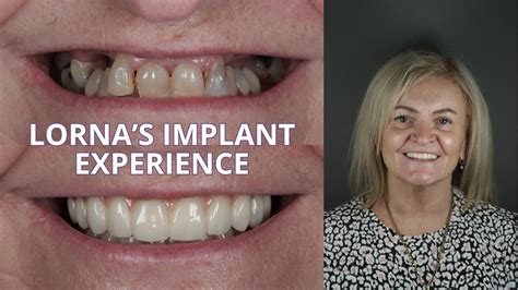 Lorna S Dental Implant Experience Youtube