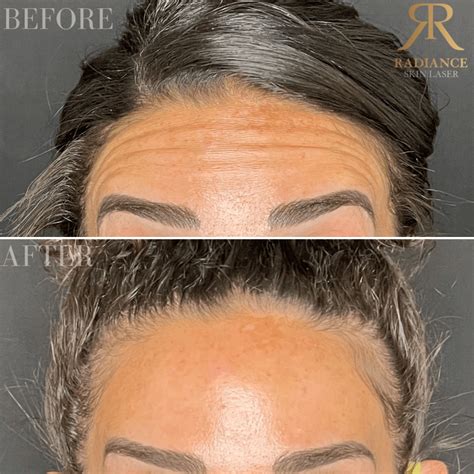 Before And After Radiance Skin And Laser