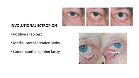 Ectropion And Entropion Ophthalmology Etiology Management