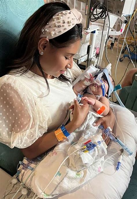 Formerly Conjoined Twins Go Home After 6 Hour Surgery To Separate Them Good Morning America