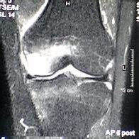 Year Old Man With A Large Bme In The Medial Femoral Condyle Not