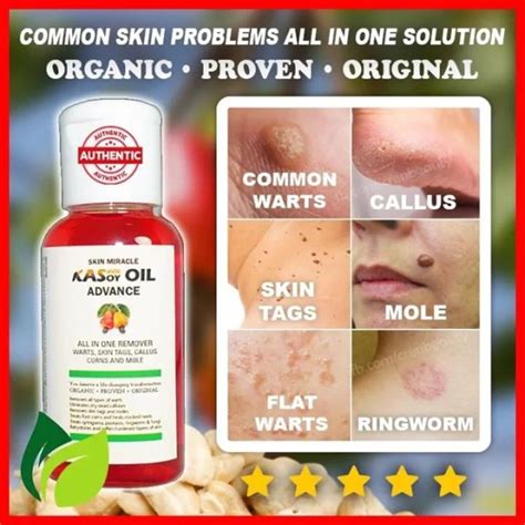 Miracle Warts Remover Skin Tag Mole And More Original Pure Kasoy Oil