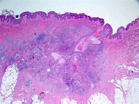 Hidradenitis Suppurativa Scalp