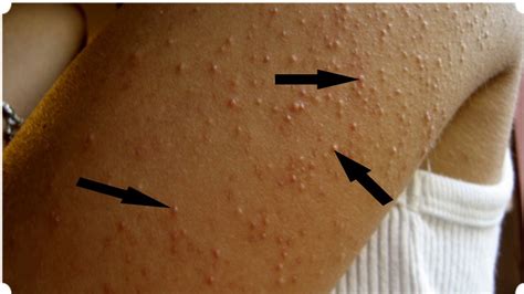 How To Get Rid Of Keratosis Pilaris Chicken Skin Youtube